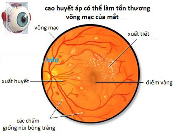 Tăng huyết áp gây tổn thương mắt cho bạn cần cẩn thận